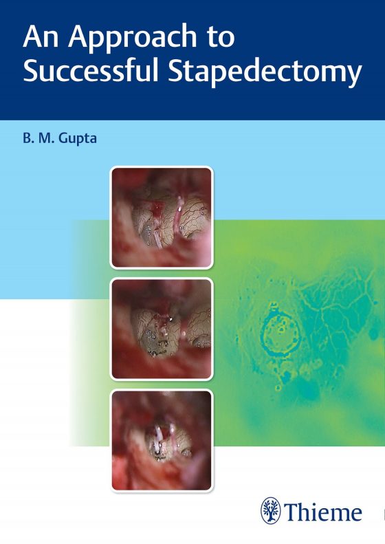 An Approach to Successful Stapedectomy Original PDF