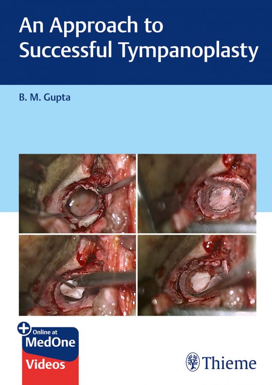An Approach to Successful Tympanoplasty Original PDF
