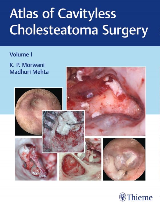 Atlas of Cavityless Cholesteatoma Surgery, Vol 1 Original PDF