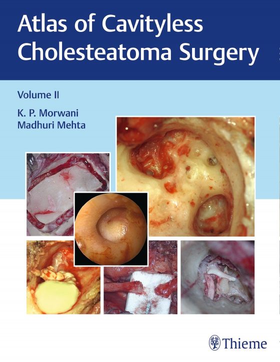 Atlas of Cavityless Cholesteatoma Surgery, Vol 2 Original PDF
