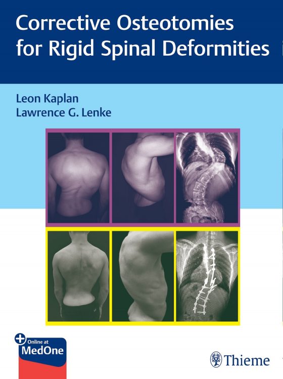 Corrective Osteotomies for Rigid Spinal Deformities Original PDF