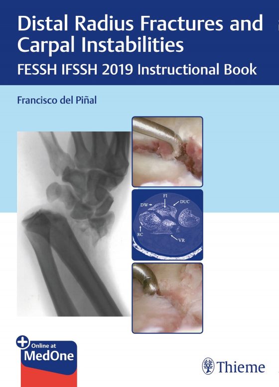 Distal Radius Fractures and Carpal Instabilities Original PDF
