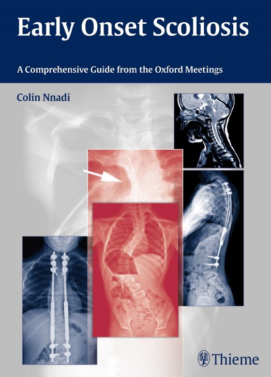 Early Onset Scoliosis Original PDF
