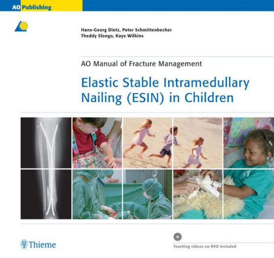 Elastic Stable Intramedullary Nailing (ESIN) in Children Original PDF
