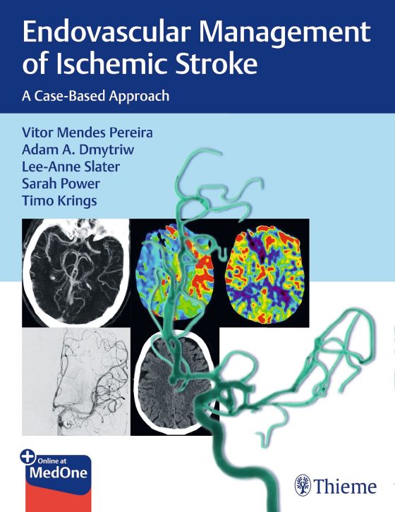 Endovascular Management of Ischemic Stroke Original PDF