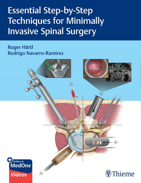 Essential Step-by-Step Techniques for Minimally Invasive Spinal Surgery Original PDF
