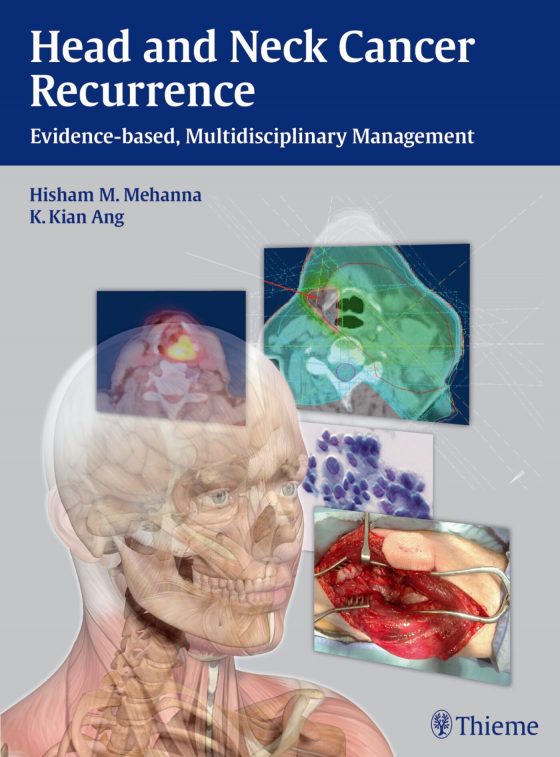 Head and Neck Cancer Recurrence Original PDF