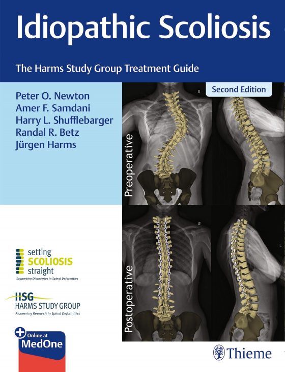 Idiopathic Scoliosis Original PDF