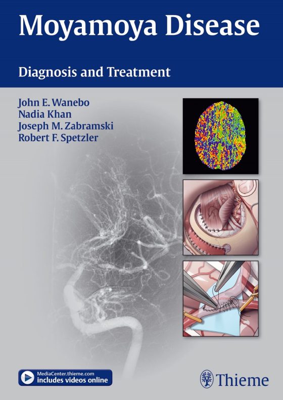Moyamoya Disease Original PDF