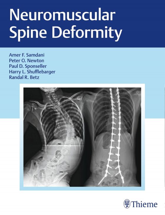 Neuromuscular Spine Deformity Original PDF
