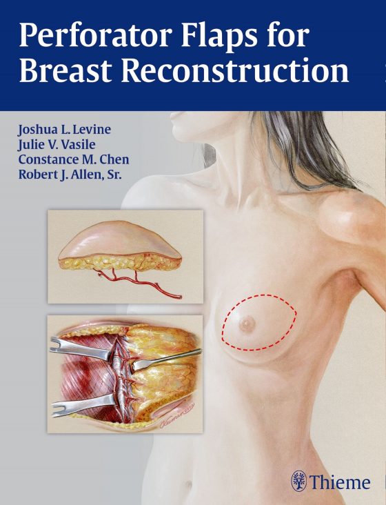 Perforator Flaps for Breast Reconstruction Original PDF