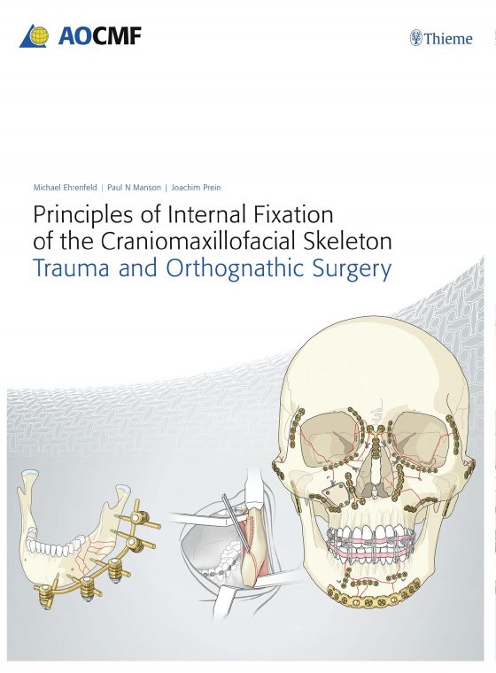 Principles of Internal Fixation of the Craniomaxillofacial Skeleton Original PDF