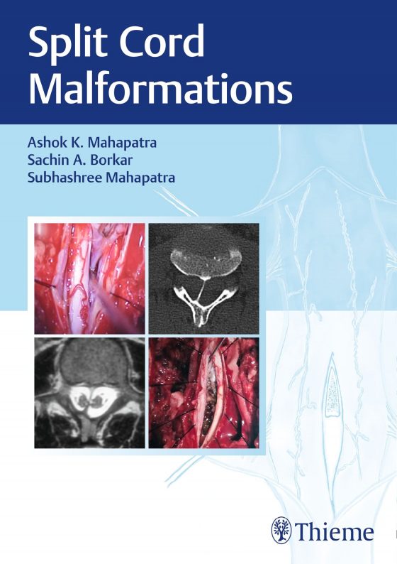Split Cord Malformations Original PDF